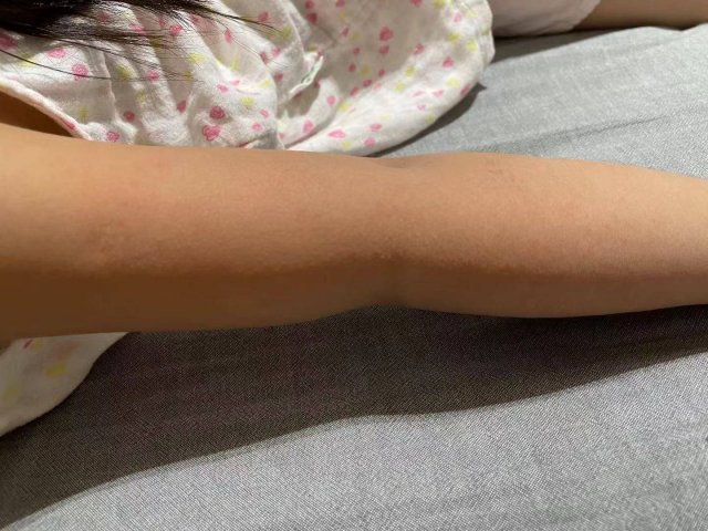 小孩出疹子不能吃什么菜「小孩出疹子不能吃什么东西」