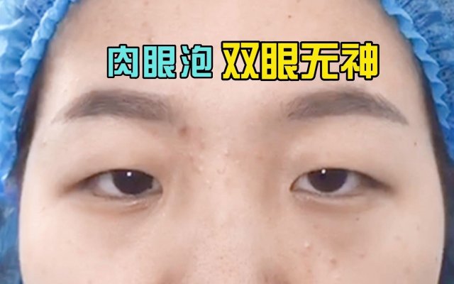 男性消除黑眼圈的几种有效方法，让你重拾明亮双眼