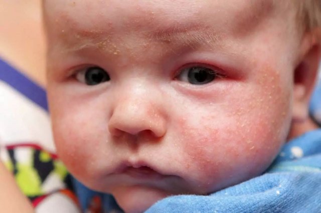 婴儿湿疹反反复复好不了怎么办呢(婴儿湿疹最佳治疗方法