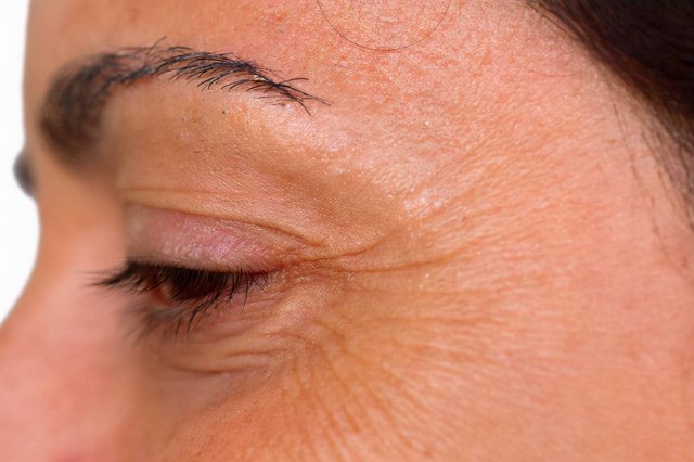 揭秘眼部皱纹的六大成因：如何有效预防和改善？