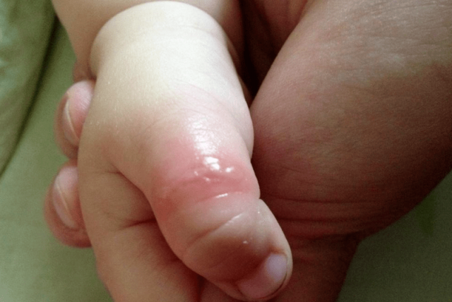 宝宝虫咬皮炎快速有效的方法「怎样预防宝宝夏季的虫咬皮炎」